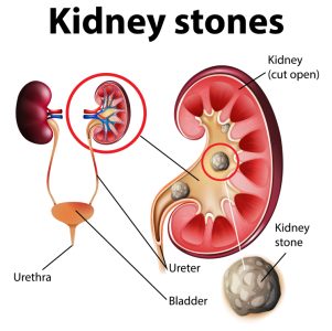 kidneystones